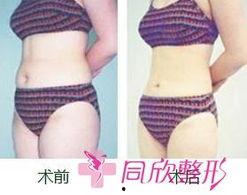 肚子吸脂视频全过程,肚子吸脂手术全过程