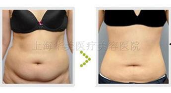肚子吸脂视频全过程,肚子吸脂手术全过程