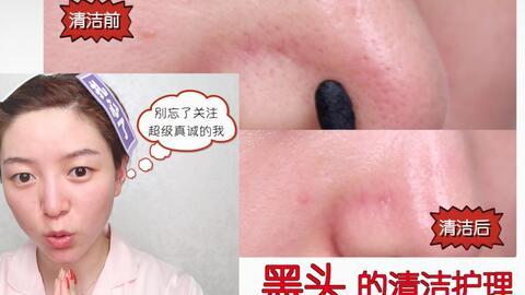 超大黑头去除视频,超大黑头去除视频深度解析